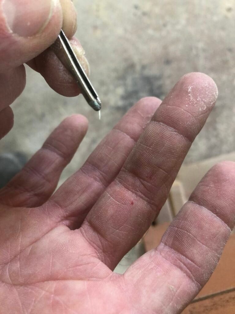 splinters hurt