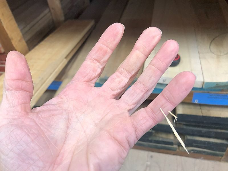 woodworking injuries